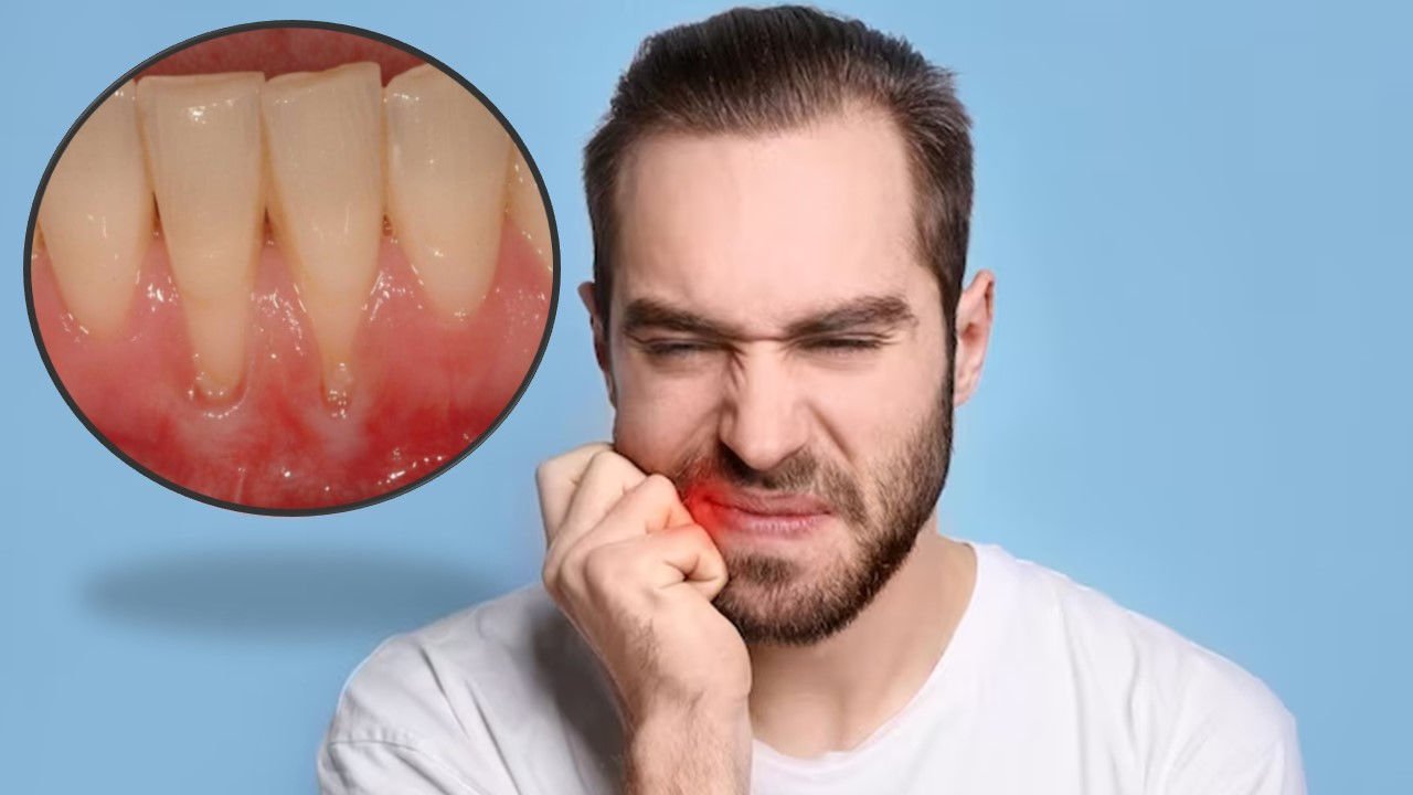 The Danger of Receding Gums