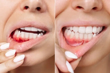 How Gum Tissue Regenerates