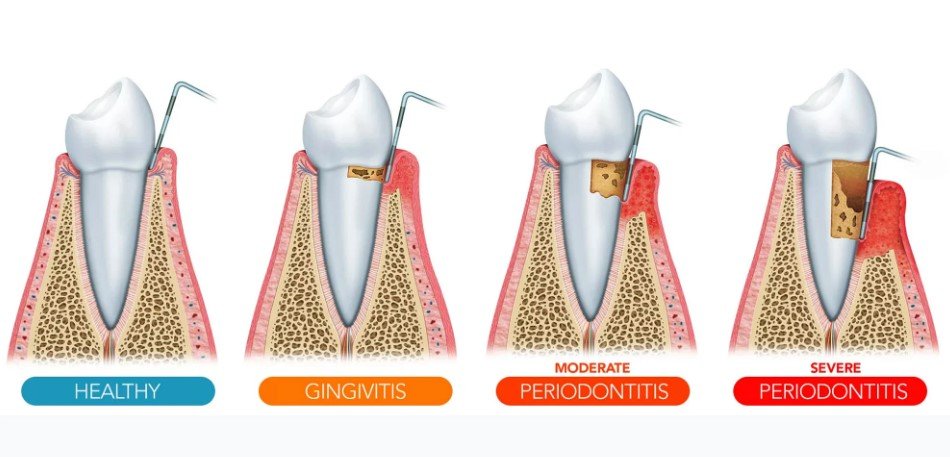 4 Stages of Gum Recession