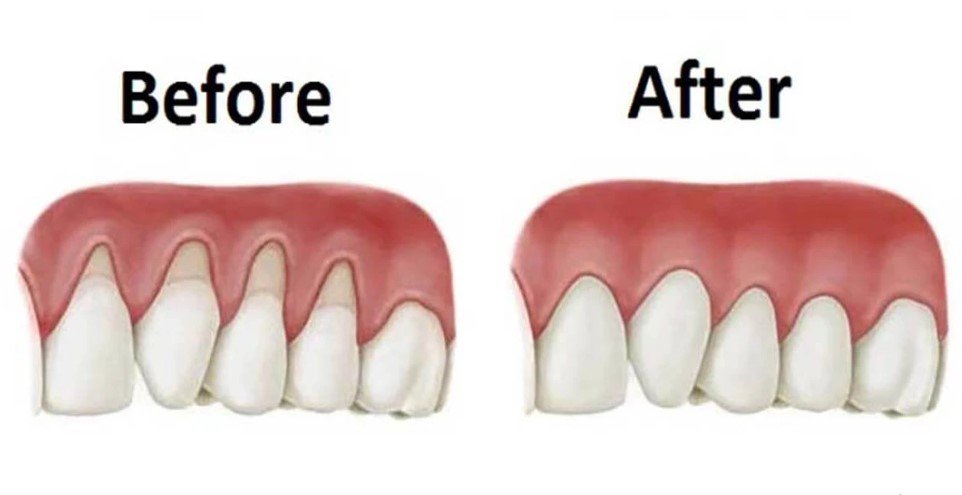 Does Receding Gums Grow Back
